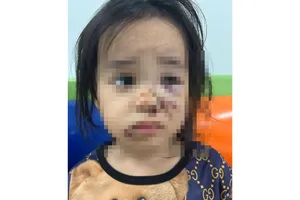 Bé gái 4 tuổi nhập viện vì bị chó thả rông tấn công