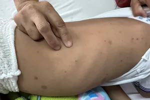Hai trẻ bị ong đốt nguy kịch, phải nhập viện cấp cứu