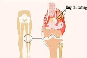 Bệnh nhân ung thư xương khó tiếp cận phương pháp điều trị tiên tiến