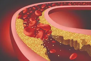 Đột phá trong điều trị rối loạn mỡ máu