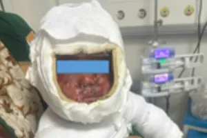 Cấp cứu thành công bé trai 9 tháng tuổi bỏng nặng do nước sôi