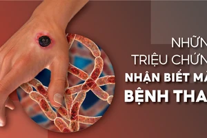 Những triệu chứng nhận biết mắc bệnh than