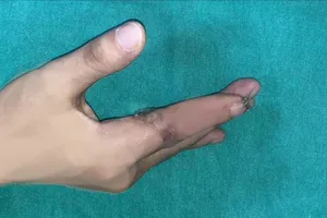 Lần đầu tiên, vi phẫu thành công cứu sống ngón tay của một thủy thủ bị đứt rời sau 25 giờ