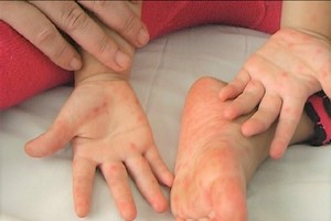 在過去一週內，手足口病例與平均4週前相比增加4倍。