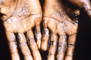 猴痘“類天花”在全球多國擴散