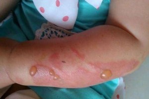 4步急救被開水燙傷小兒