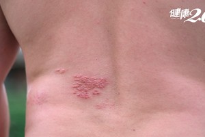 莫名頭痛腰痛當心長“皮蛇”