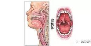 兒童扁桃體術後要如何護理？