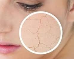 4個小方法可快速緩解皮膚乾燥脫皮