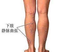 輕鬆緩解職場人靜脈曲張