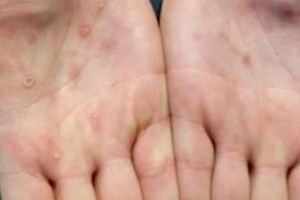 猴痘的病變常常出現在手掌上。