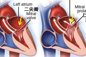 年輕人心悸胸悶當心“二尖瓣膜脫垂”