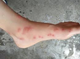 濕疹小心是腸道累積太多代謝廢物