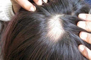 容易上火體質易出現圓禿