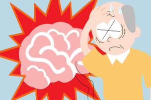 卒中後警惕抑鬱症