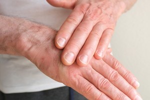 年纪愈大皮肤愈薄，皮肤薄小心病变危机！