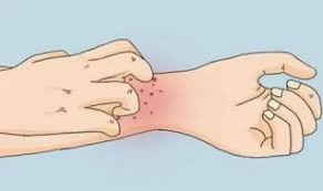 特应性皮炎和湿疹如何分清？