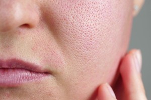 ３个日常保养毛孔粗大方法