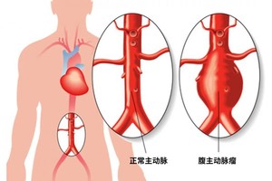 这种瘤不易发现但却十分凶险