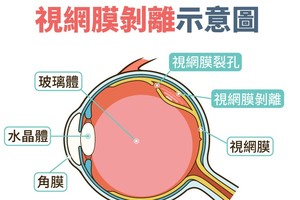 小心视网膜剥离会失明！