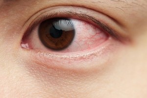 眼睛也会心肌梗塞！