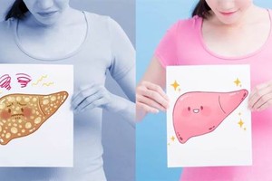 迅速减肥、长期吃素当心“瘦”出脂肪肝