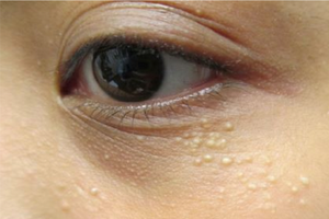 认识６种常见脸部肉芽