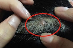 头皮总是长疙瘩和脓包！ 或是“4种疾病”信号
