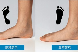 儿童扁平足就是一个需要重视的问题。