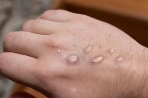 瑞典出现非洲以外首例猴痘新毒株感染病例