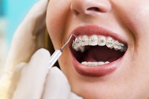 做牙齿矫正前，千万别被谣言忽悠！
