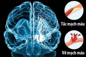 ĐBSCL: Mỗi năm có hơn 10.000 trường hợp đột quỵ