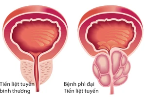 ​Tìm ra lối thoát mới cho bệnh phì đại tiền liệt tuyến