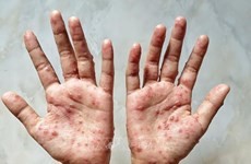 Health Ministry recommends measures to prevent monkeypox