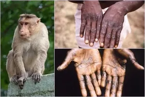 Dong Nai reports first case of Monkeypox