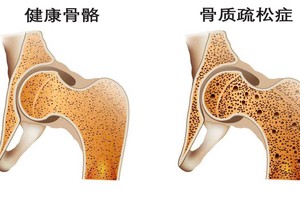 胖人和瘦人，谁更容易骨质疏松？