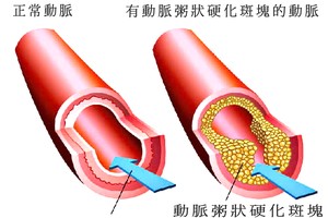 警惕高血脂的腿部５大迹象！