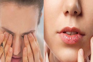 口干眼干谨防干燥综合症