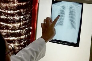 世卫公布首个获预认证的结核病诊断检测方法