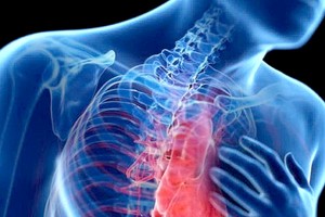 慢阻肺的典型症状为呼吸困难。