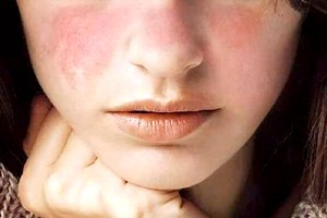 冬天皮肤干痒是多人遇上的现象。