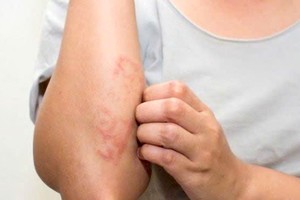 特应性皮炎患者在冬季洗护时应特别注意。