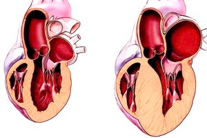 正常心肌与肥厚型心肌。