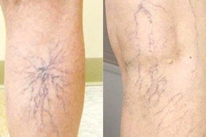 大隐静脉曲张不只是影响美观，还可能进展为严重并发症的慢性疾病。