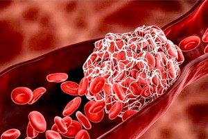 预防血栓从饮食和运动做起。