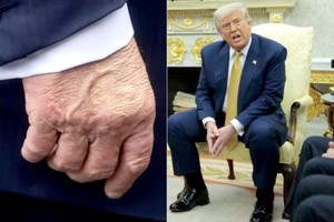 特朗普被诊断患有慢性静脉功能不全