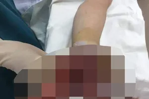 Bàn tay của V. bị dập nát khi điện thoại phát nổ khi vừa sạc, vừa sử dụng