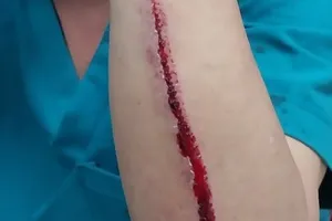 Điều dưỡng Bệnh viện Đa khoa Bình Phước bị hành hung khi đang làm việc