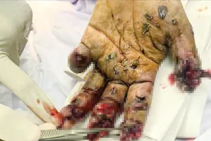 Chơi pháo tự chế, bé trai bị dập nát bàn tay 