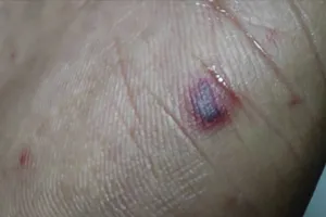 Điều trị thành công ca bệnh do não mô cầu 